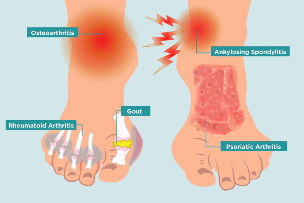 Arthritis: What You Need To Know – Marlborough Podiatry